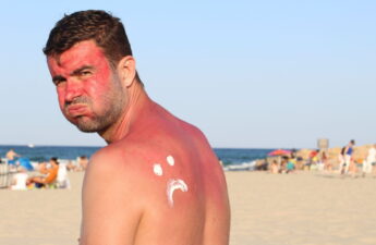 Man getting sunburned at the beach